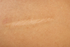close up of scar on skin